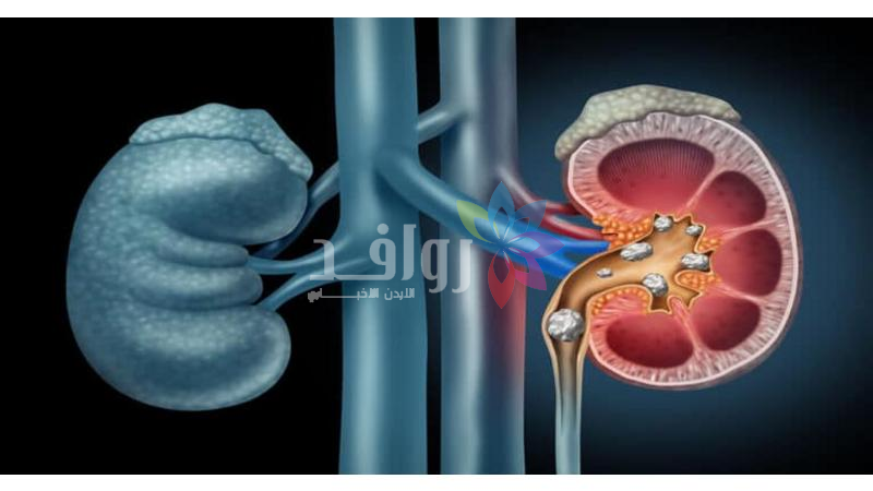 كيف تتعامل مع حصى الكلى أثناء الصيام؟