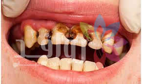تسوس الأسنان: الخطر الصامت الذي يستهين به الكثيرون
