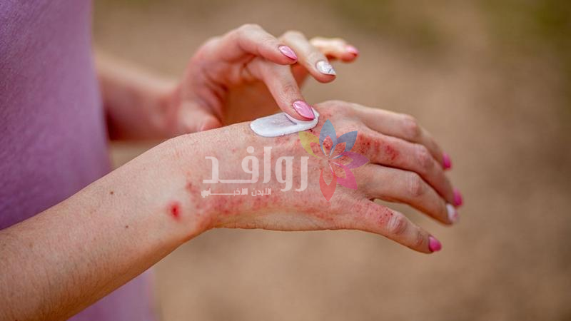 الولايات المتحدة.. سحب عاجل لكريم شهير يعالج اﻷكزيما بسبب تلوثه ببكتيريا قاتلة