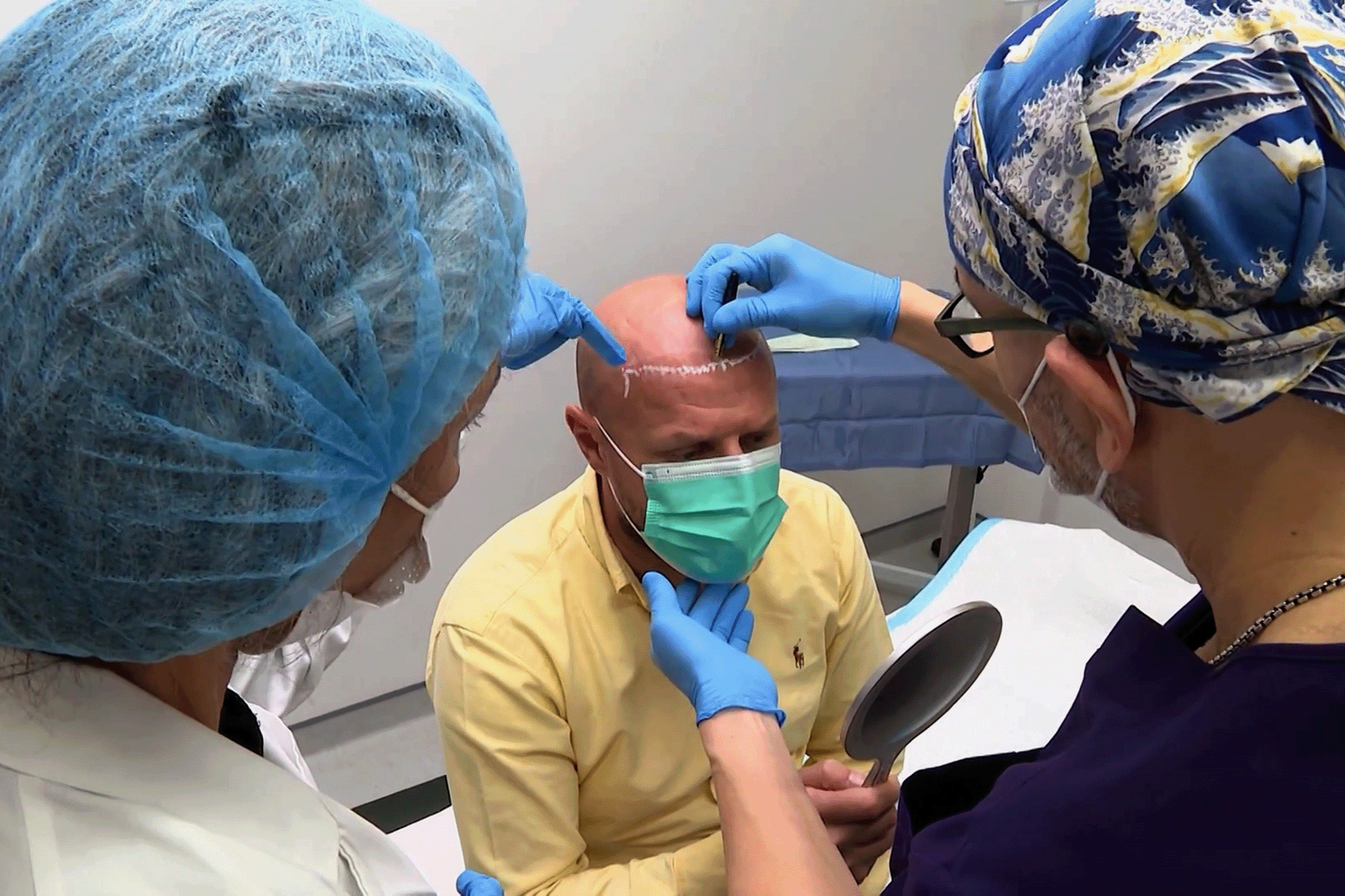 تقنية بيوفايبر لزراعة الشعر الحل التجميلي الفوري في قطر