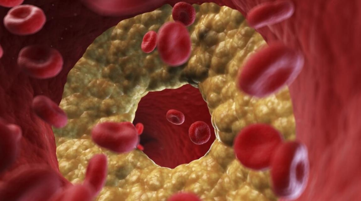 حمية غذائية شائعة قد تسبب ارتفاعا خطيرا في الكوليسترول
