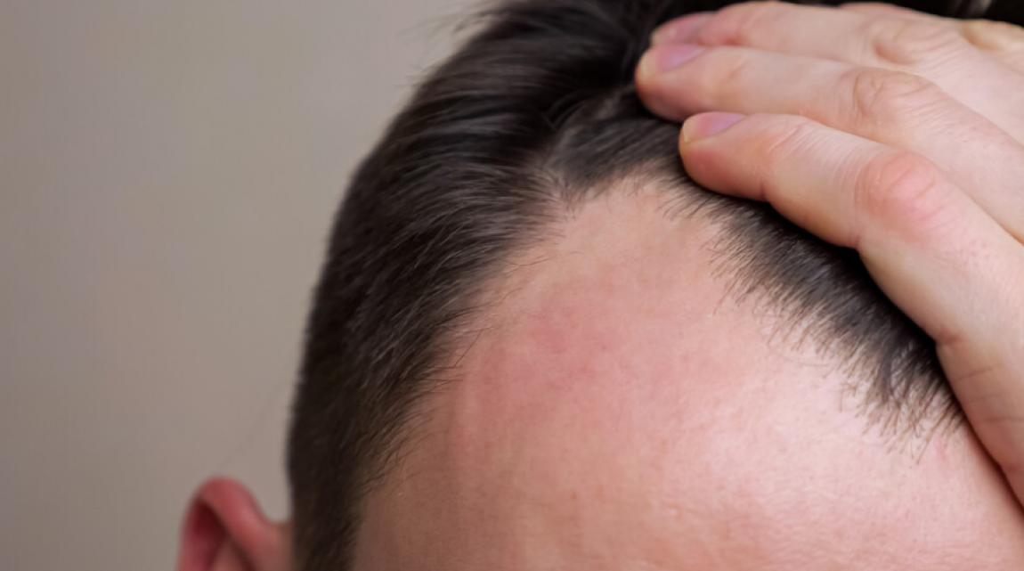 أدوية إنقاص الوزن قد ترتبط بتساقط الشعر لدى الرجال