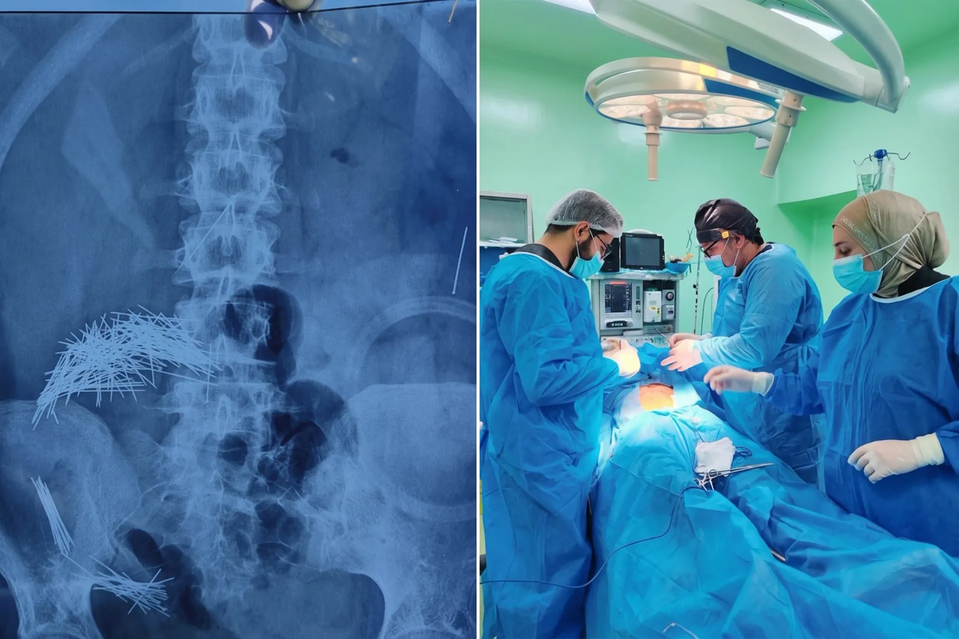 معجزة طبية في العراق.. استخراج مئات الاجسام الحادة من بطن رجل في عملية نادرة
