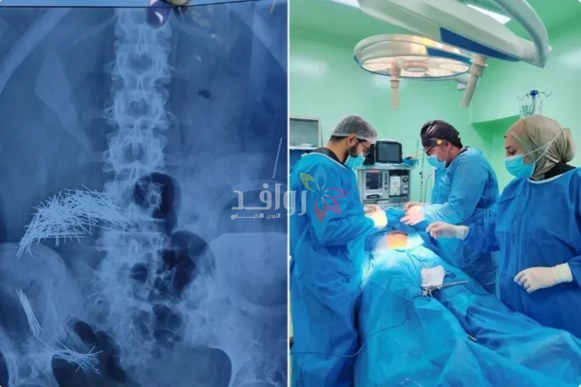 استخراج 214 إبرة ودبوسا من بطن رجل في العراق